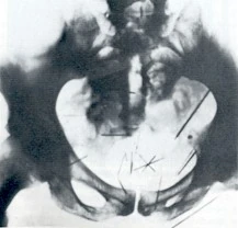 Radiografia pelvica di Albert Fish con aghi da cucito (processo 1935)
